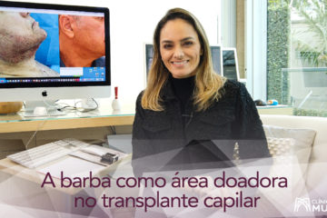 A barba pode ser área doadora para um transplante capilar, quando não houver fios suficientes na região posterior do couro cabeludo.